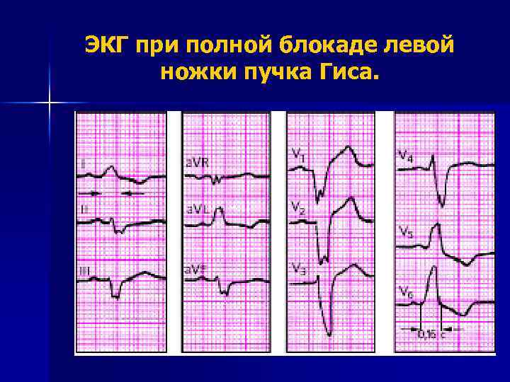 ЭКГ при полной блокаде левой ножки пучка Гиса. 