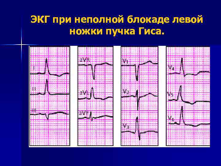 ЭКГ при неполной блокаде левой ножки пучка Гиса. 