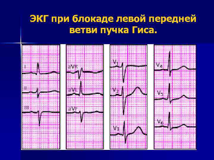 ЭКГ при блокаде левой передней ветви пучка Гиса. 