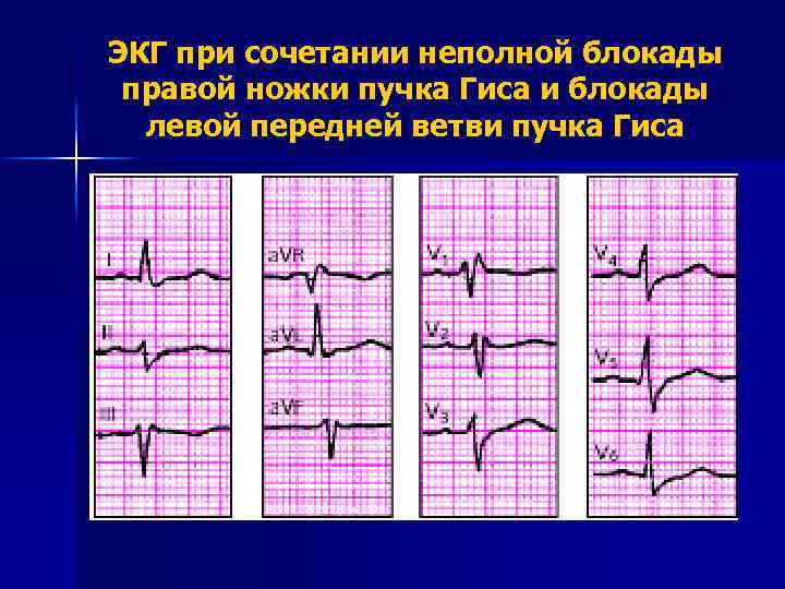 ЭКГ при сочетании неполной блокады правой ножки пучка Гиса и блокады левой передней ветви