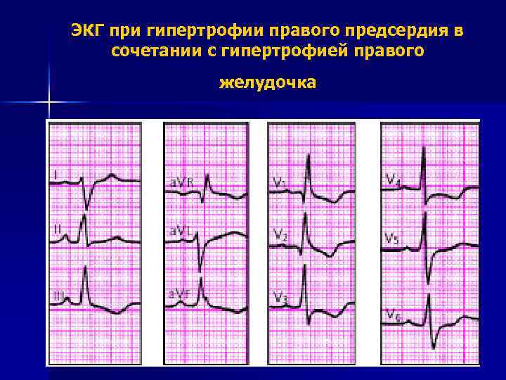 ЭКГ при гипертрофии правого предсердия в сочетании с гипертрофией правого желудочка 