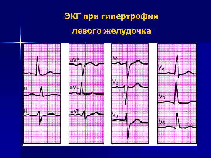 ЭКГ при гипертрофии левого желудочка 