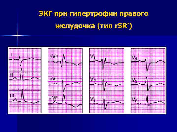 ЭКГ при гипертрофии правого желудочка (тип r. SR') 