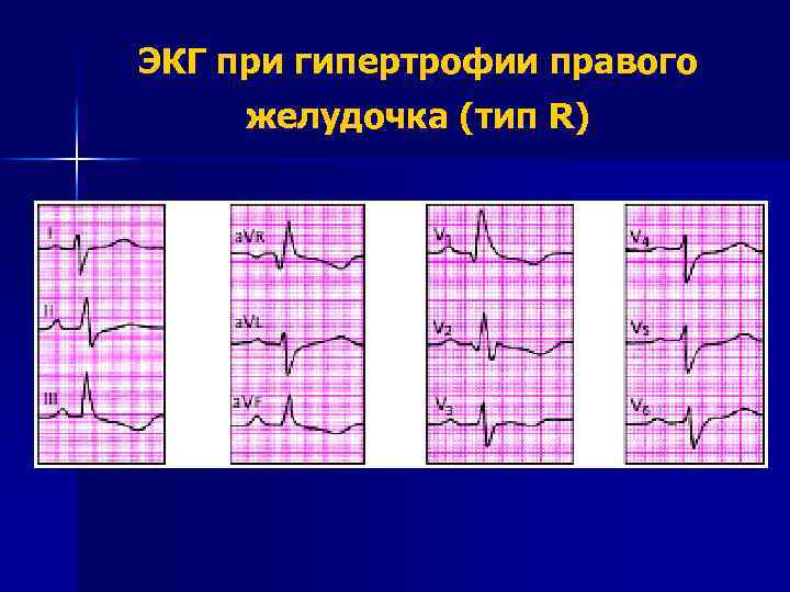 ЭКГ при гипертрофии правого желудочка (тип R) 