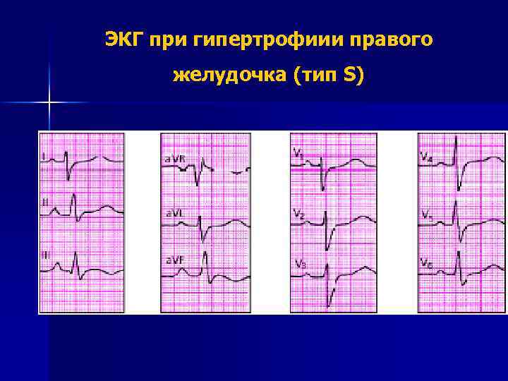 ЭКГ при гипертрофиии правого желудочка (тип S) 