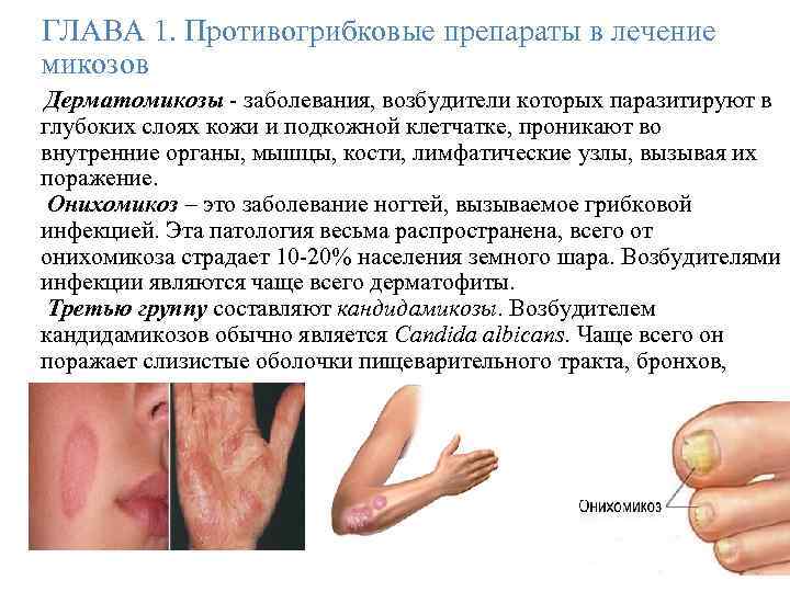 ГЛАВА 1. Противогрибковые препараты в лечение микозов Дерматомикозы - заболевания, возбудители которых паразитируют в
