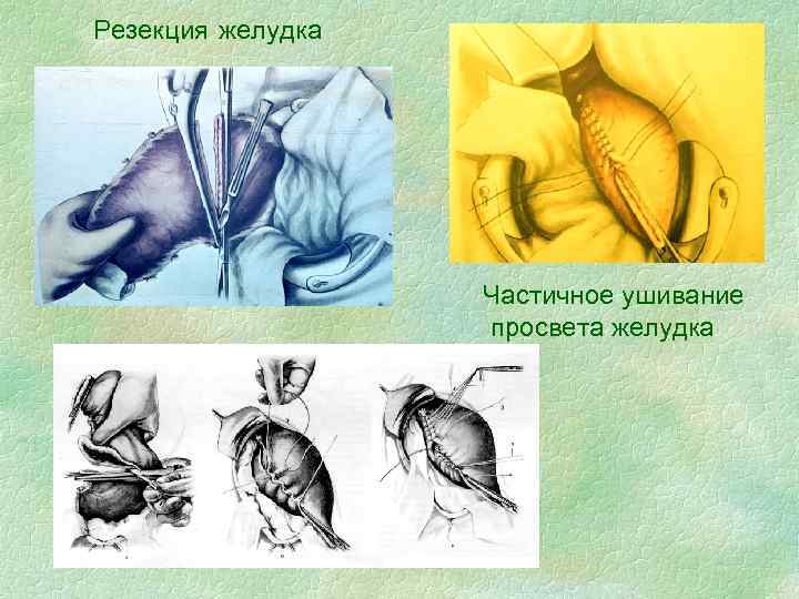 Резекция желудка Частичное ушивание просвета желудка 