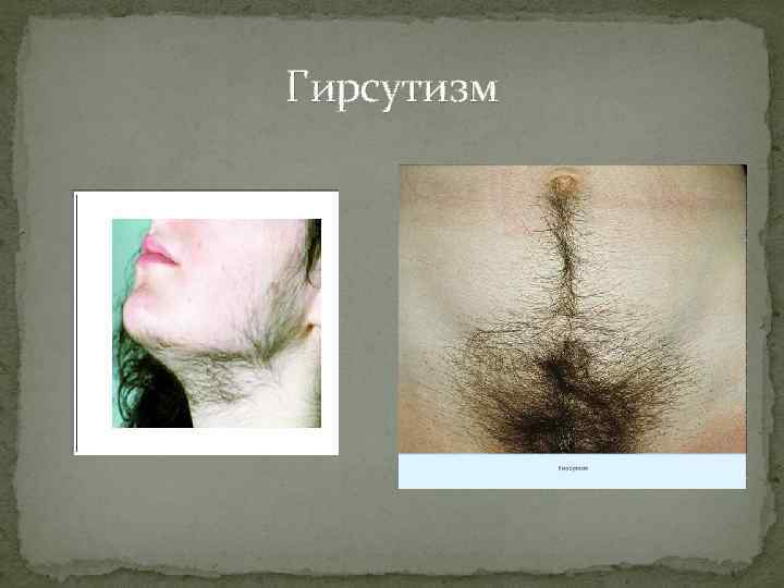 Гирсутизм 