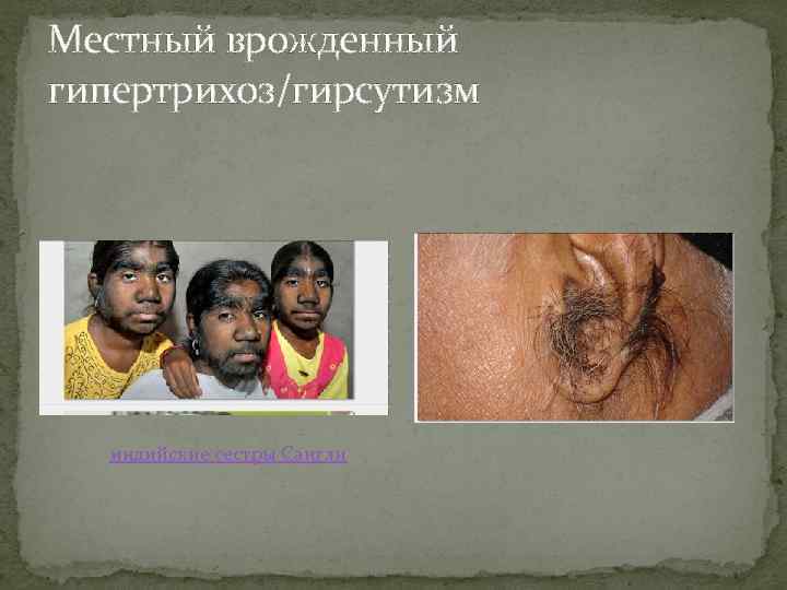 Местный врожденный гипертрихоз/гирсутизм индийские сестры Сангли 