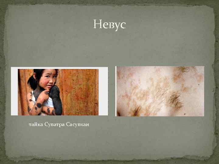 Невус тайка Супатра Сасупхан 