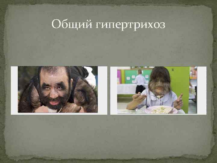 Общий гипертрихоз 