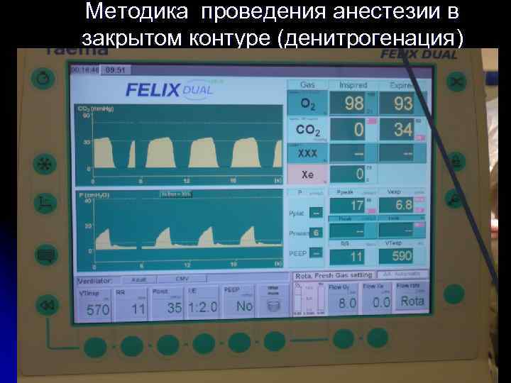 Методика проведения анестезии в закрытом контуре (денитрогенация) 