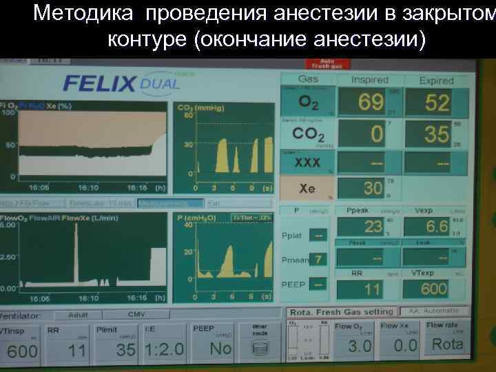 Методика проведения анестезии в закрытом контуре (окончание анестезии) 