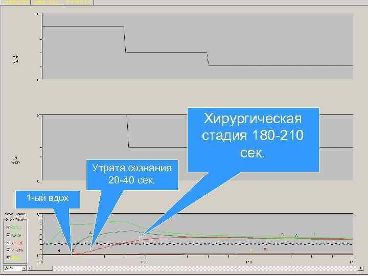 Хирургическая стадия 180 -210 сек. Утрата сознания 20 -40 сек. 1 -ый вдох 