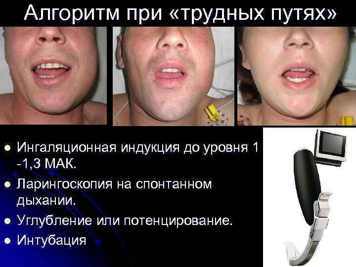 Алгоритм при «трудных путях» l l Ингаляционная индукция до уровня 1 -1, 3 МАК.