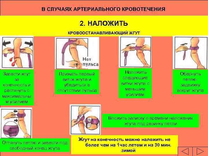В СЛУЧАЯХ АРТЕРИАЛЬНОГО КРОВОТЕЧЕНИЯ 2. НАЛОЖИТЬ КРОВООСТАНАВЛИВАЮЩИЙ ЖГУТ Завести жгут за конечность и растянуть