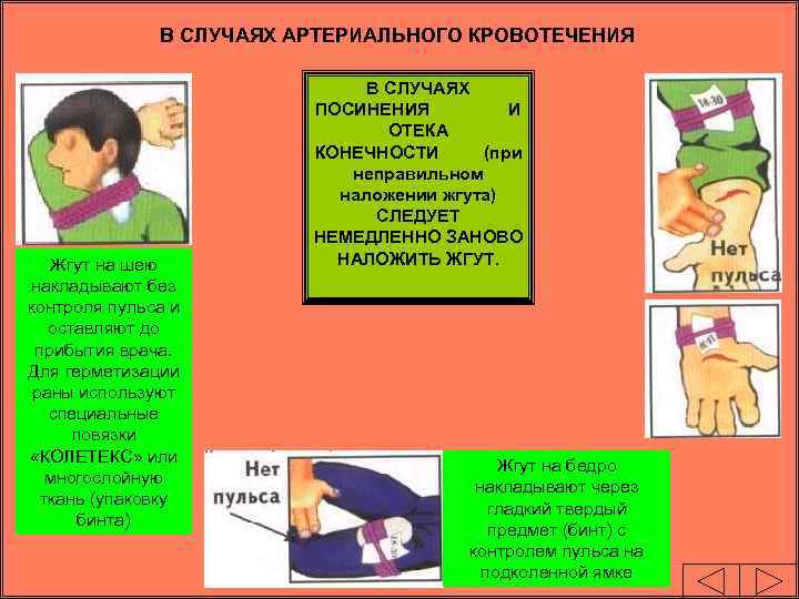 В СЛУЧАЯХ АРТЕРИАЛЬНОГО КРОВОТЕЧЕНИЯ Жгут на шею накладывают без контроля пульса и оставляют до