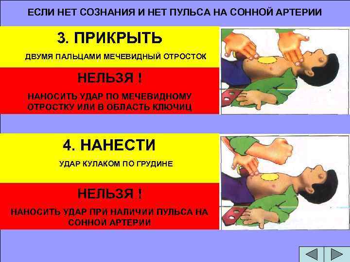 ЕСЛИ НЕТ СОЗНАНИЯ И НЕТ ПУЛЬСА НА СОННОЙ АРТЕРИИ 3. ПРИКРЫТЬ ДВУМЯ ПАЛЬЦАМИ МЕЧЕВИДНЫЙ
