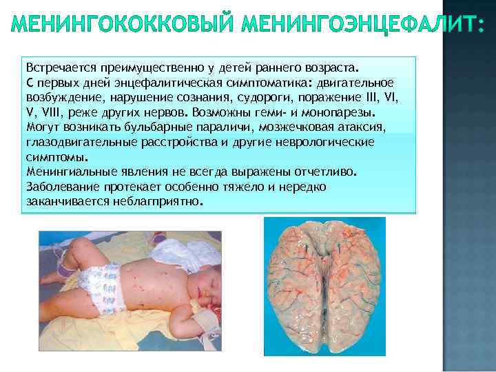 Встречается преимущественно у детей раннего возраста. С первых дней энцефалитическая симптоматика: двигательное возбуждение, нарушение