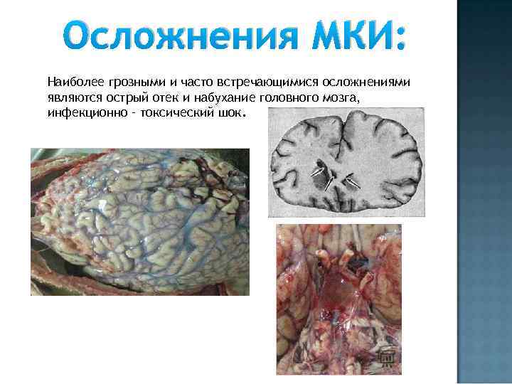 Осложнения МКИ: Наиболее грозными и часто встречающимися осложнениями являются острый отек и набухание головного