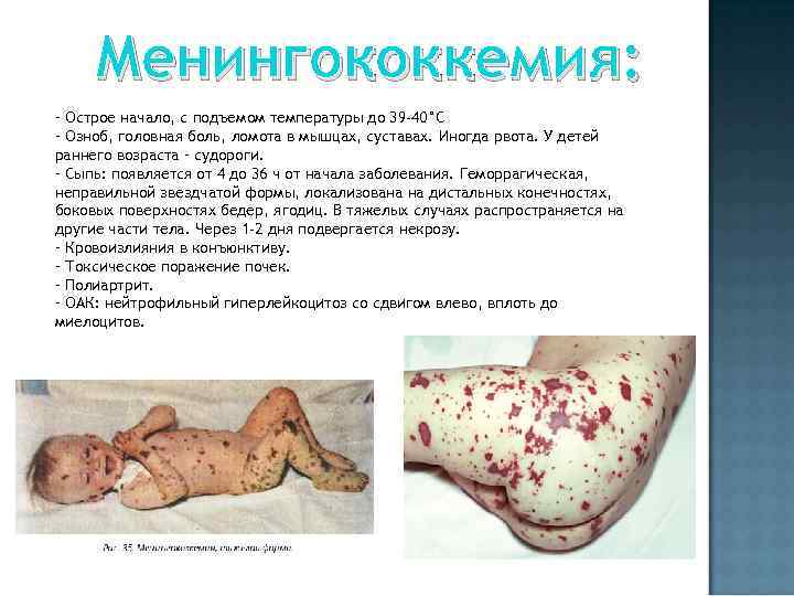 Менингококкемия: - Острое начало, с подъемом температуры до 39 -40°С - Озноб, головная боль,