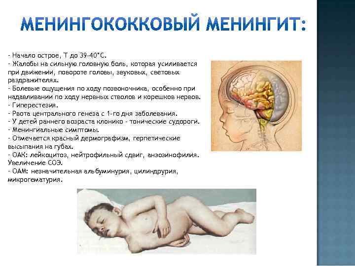 - Начало острое, Т до 39 -40°С. - Жалобы на сильную головную боль, которая