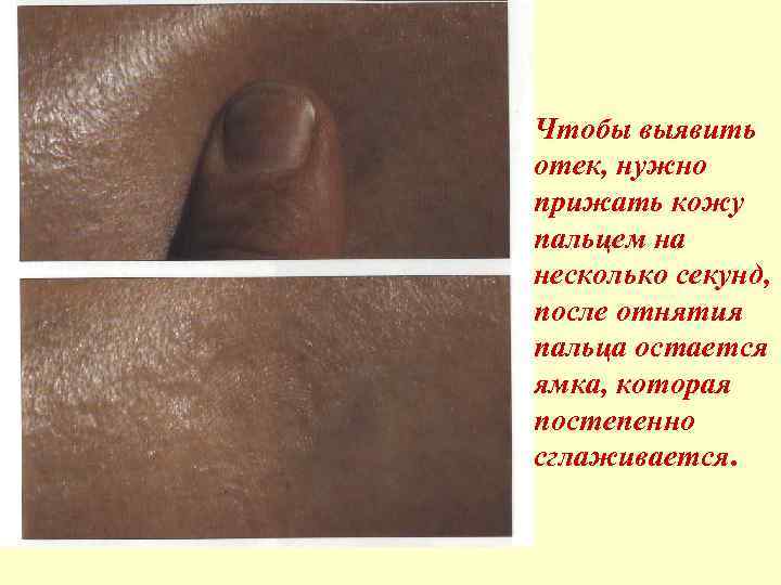Чтобы выявить отек, нужно прижать кожу пальцем на несколько секунд, после отнятия пальца остается