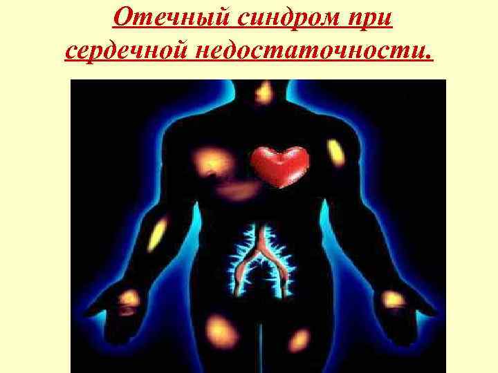 Отечный синдром при сердечной недостаточности. 