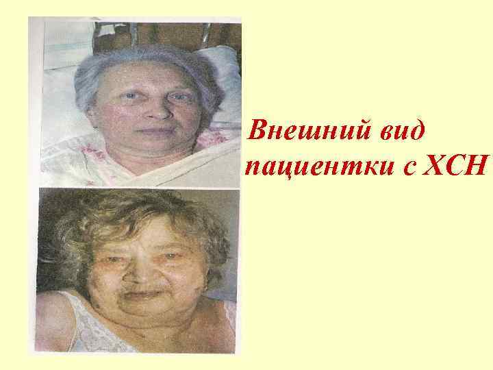  • Внешний вид пациентки с ХCН 