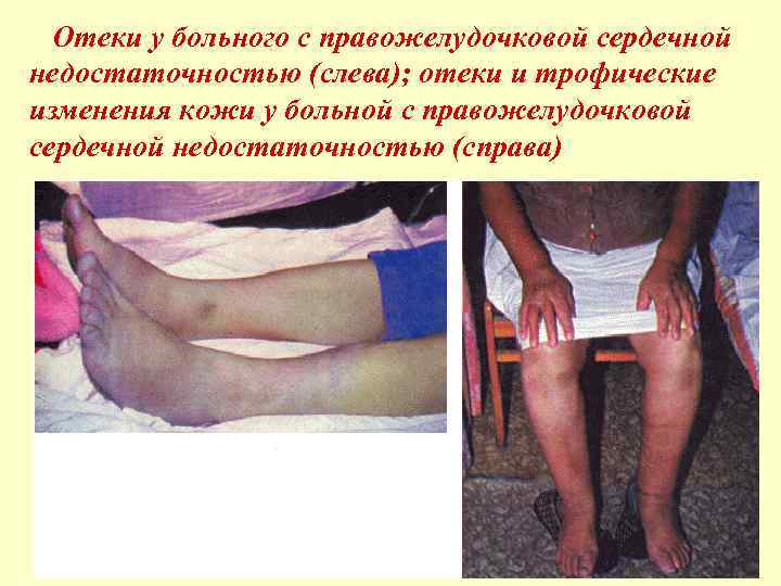 Отеки у больного с правожелудочковой сердечной недостаточностью (слева); отеки и трофические изменения кожи у
