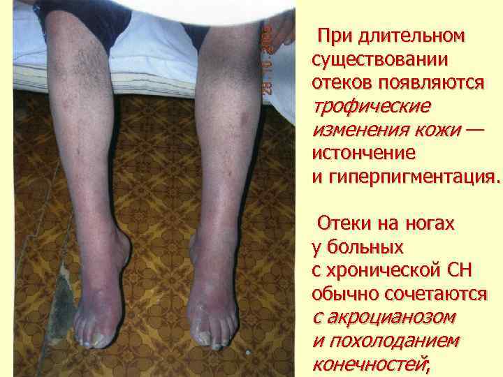  При длительном существовании отеков появляются трофические изменения кожи — истончение и гиперпигментация. Отеки