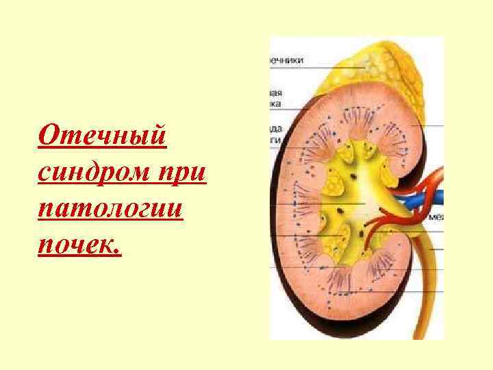 Отечный синдром при патологии почек. 