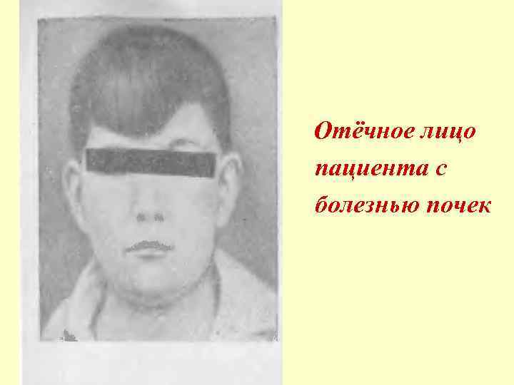 . Отёчное лицо пациента с болезнью почек 