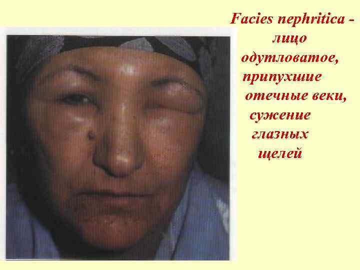 Facies nephritica лицо одутловатое, припухшие отечные веки, сужение глазных щелей 