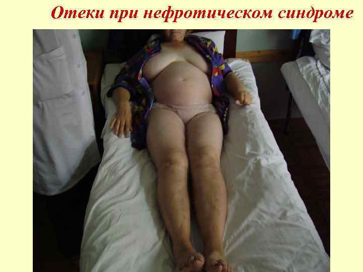 Отеки при нефротическом синдроме 