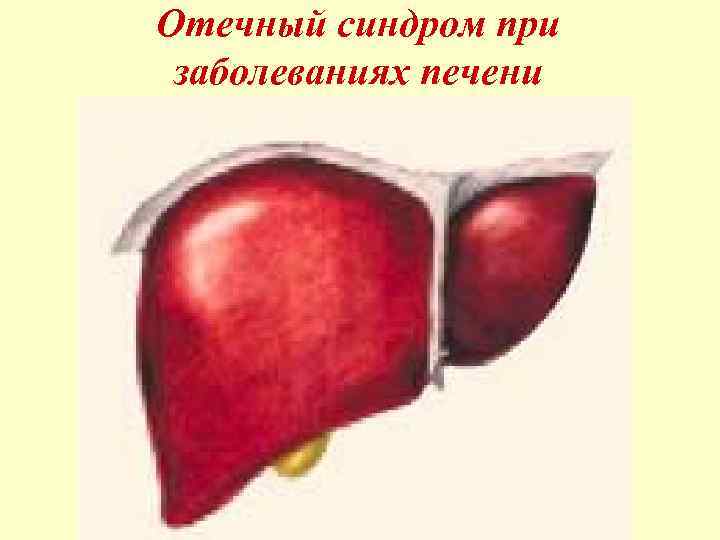 Отечный синдром при заболеваниях печени 
