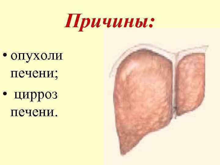Причины: • опухоли печени; • цирроз печени. 