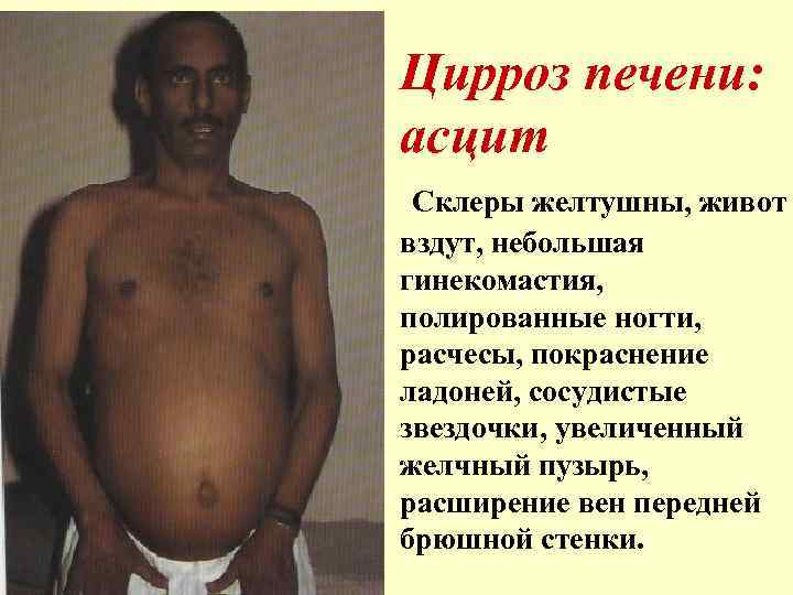 Цирроз печени: асцит Склеры желтушны, живот вздут, небольшая гинекомастия, полированные ногти, расчесы, покраснение ладоней,