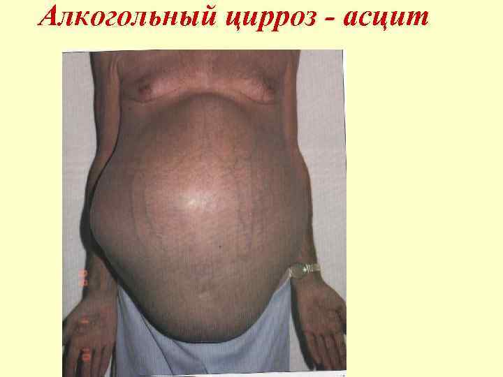  Алкогольный цирроз - асцит 