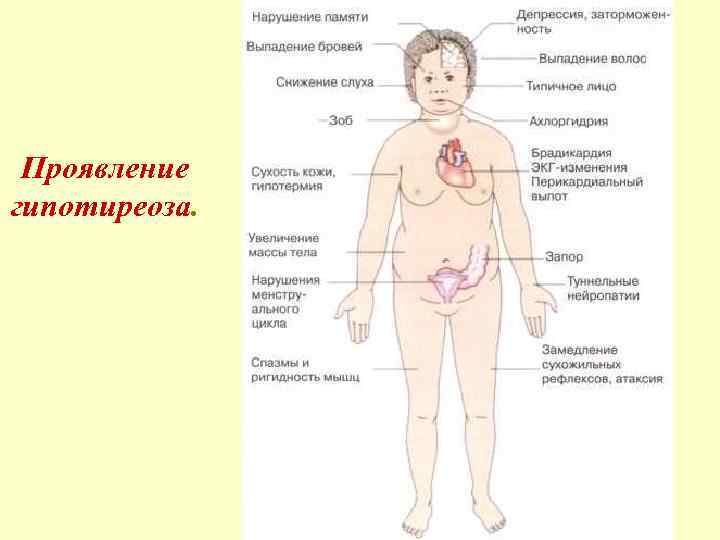 Проявление гипотиреоза. 