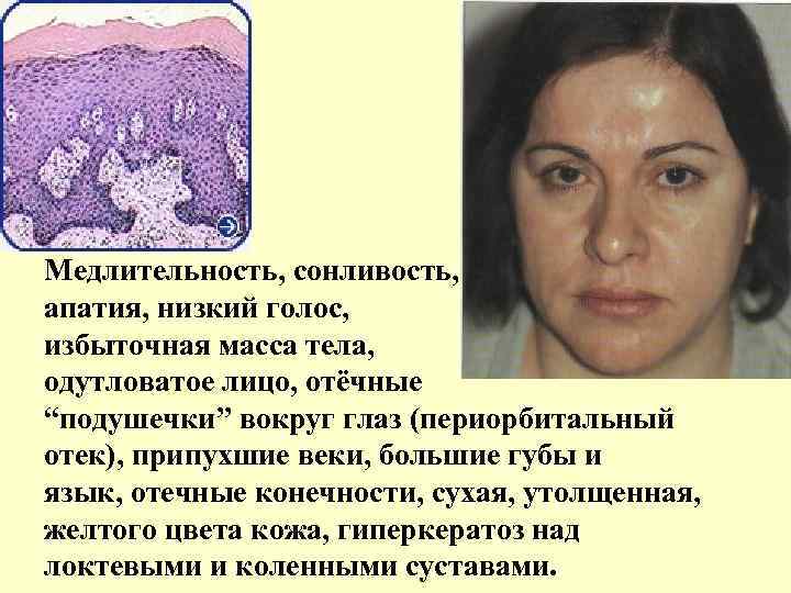 Медлительность, сонливость, апатия, низкий голос, избыточная масса тела, одутловатое лицо, отёчные “подушечки” вокруг глаз