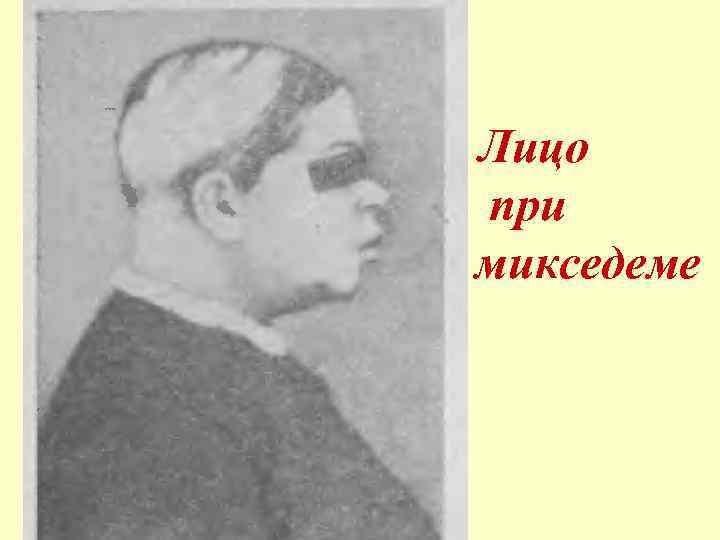  / Лицо при микседеме 