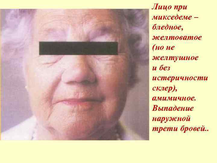 Лицо при микседеме – бледное, желтоватое (но не желтушное и без истеричности склер), амимичное.