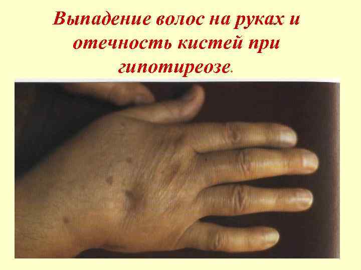 Выпадение волос на руках и отечность кистей при гипотиреозе. 