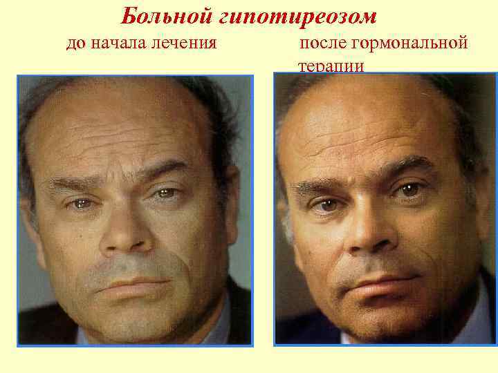 Больной гипотиреозом до начала лечения после гормональной терапии 