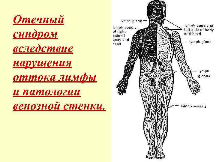 Отечный синдром вследствие нарушения оттока лимфы и патологии венозной стенки. 