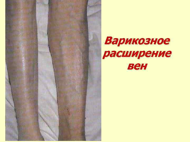 Варикозное расширение вен 