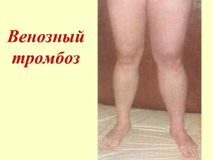 Венозный тромбоз 