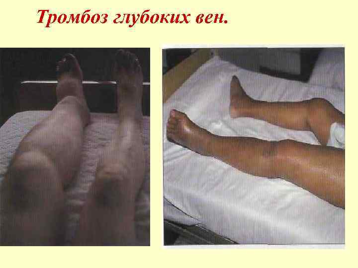 Тромбоз глубоких вен. 