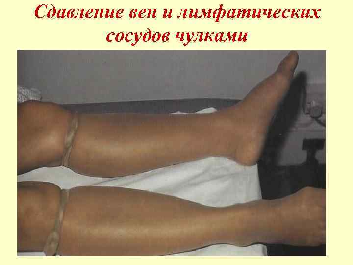 Сдавление вен и лимфатических сосудов чулками 